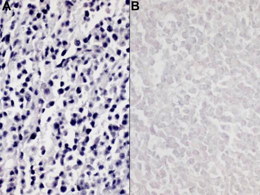 Figure 1. Representative results of Epstein-Barr virus–encoded RNA-1 in situ hybridization (EBER ISH). (A) positive EBER ISH; (B) negative EBER ISH. Images were captured using a Polaroid DMC2 digital microscope camera (Polaroid, Tokyo, Japan) and processed using Adobe Photoshop 7.0 (Adobe Systems, Seattle, WA). Original magnification, ×200.