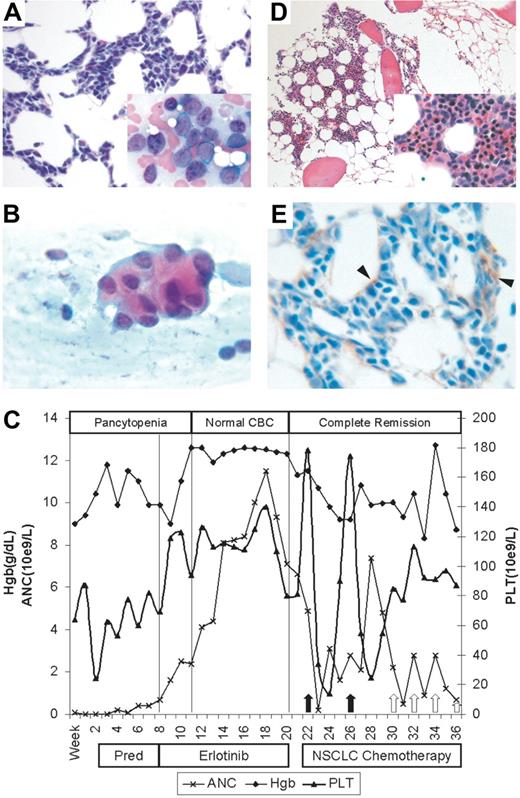 Figure 1. Erlotinib-induced complete remission in AML lacking EGFR expression. (A) Pretreatment bone marrow with up to 90% of cellularity composed of myeloid blasts (hematoxylin-eosin; magnification, × 400). Insert: Wright-Giemsa stain, magnification × 1000 oil. (B) Fine-needle aspiration cytology of the lung mass reveals 3D cohesive clusters of atypical epithelial cells containing intracytoplasmic mucin vacuoles, consistent with adenocarcinoma (hematoxylin-eosin; magnification, × 1000 oil). (C) Graph of peripheral blood counts over time. From weeks 1 to 8, patient remained pancytopenic with AML. Three weeks after starting erlotinib therapy, patient's absolute neutrophil count (ANC) and hemoglobin (Hgb) normalized, while platelet counts exceeded 100 × 109/L. Complete remission was documented by bone marrow biopsy on week 20 (panel D). Peripheral counts show recovery after each round of combination chemotherapy for NSCLC (arrows), suggesting adequate marrow reserve while remaining in complete remission. (D) Posterlotinib bone marrow with variable (average 30%) cellularity and trilineage maturing hematopoiesis. Myeloblasts are less than 3% (hematoxylin-eosin; magnification, × 200). Insert: magnification, × 400. (E) Immunohistochemical staining of initial bone marrow biopsy for EGFR. Only stromal cells (arrowheads) stain positively. Myeloblasts are EGFR negative (magnification, × 1000 oil). Images were acquired using an Olympus BX51 microscope (Olympus, Tokyo, Japan) equipped with either a 20×/0.5 NA, 40×/0.65 NA, or 100×/1.3 NA oil objective and mounted DP12 digital camera, and were further processed (cut out and white balanced) with Adobe Photoshop CS2 (Adobe Systems, San Jose, CA).