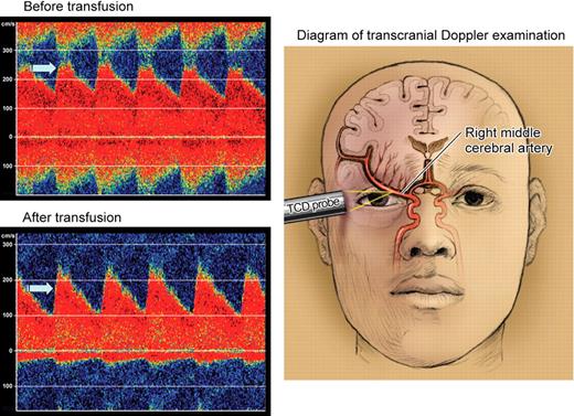 Baseline TCD measurement of velocity from the MCA before transfusion in a young child with SCD (panel A; TCD velocity = 220 cm/sec). Panel B depicts repeat TCD of the MCA 1 year after regular red-cell transfusions (TCD velocity = 172 cm/sec). Panel C presents a schematic showing the TCD probe and the insonation of stenotic right MCA. Professional illustration by Kenneth Probst.