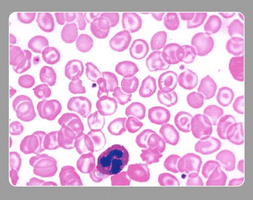 Neil Abramson, Baptist Cancer Institute