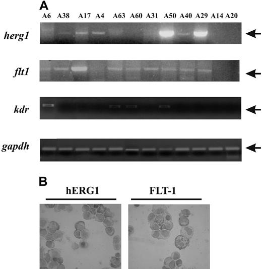 Figure 5. Expression of herg1, flt-1 and kdr transcripts in peripheral blasts from AML patients. (A) Representative RT-PCR of herg1 (upper panel, 575-bp band), flt-1 (upper middle panel, 550-bp band), kdr (lower middle panel, 660-bp band), and gapdh (bottom panel, 138-bp band) transcripts in primary AML patients. RNA extracted from blasts of AML patients was retrotranscribed and amplified for herg1, flt-1, kdr, and gapdh using primers described in “Patients, materials, and methods; Molecular biologic methods.” For case reference numbers, see Table 1. (B) Immunocytochemistry detection of hERG1 and FLT-1 protein on AML blasts. Cells from a representative AML example relating to case A49 were immunostained with an anti-pan hERG1 antibody (left) and anti FLT-1 antibody (right) as reported in “Patients, materials, and methods; Immunohistochemistry” (100× magnification). Images were acquired on a Leica DM 4000B microscope with a Leica DFC 320 photocamera (Leica Microsystems) (PL Fluotar 40×/0.70, PL Fluotar 100×/1.30 OIL objective). To determine BM angiogenesis, BM sections were stained with anti-CD34 antibodies. Vascular morphometric parameters were quantified following the procedure used by Korkolopoulou et al,30 with Leica DC Viewer software.