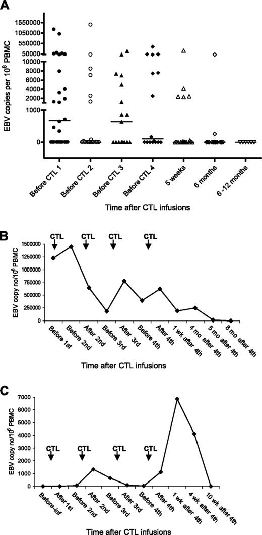 Figure 4. EBV load in a PTLD patient following CTL infusions. DNA was extracted from PBMCs and amplified using real-time PCR. The EBV copy number was calculated using a standard curve obtained from dilutions of EBV-positive Raji cell lines. (A) EBV DNA levels in PBMCs of all patients. The black bars show the median value at each time point. The level was taken as 0 where EBV DNA was undetectable. (B) EBV DNA levels in PBMCs of patient 18. (C) EBV DNA levels in PBMCs of patient 2. Pre-inf indicates before CTL infusion; wks, weeks; and mo, months.