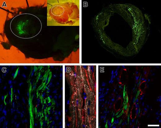 Figure 2. Engraftment of MSCs into the infarcted murine heart; lack of transdifferentiation of MSCs. (A) Massive engraftment of EGFP+ MSCs (green) in a cryoinfarcted heart 29 days after injection of 2 × 106 cells (passage 3); inset shows a transmission light picture of the heart; the infarcted area is marked by a white dotted line. (B) Cryosection of border zone of the infarction demonstrating prominent engraftment of EGFP+ MSCs (green) 7 days after injecting 1 × 105 cells (passage 4). (C) Engrafted EGFP+ MSCs (green) in the infarcted area 24 days after transplantation of 1 × 105 cells (passage 3); these displayed round or elongated shape but were negative for alpha-actinin (red) and desmin (white). (D) Cardiomyocytes in the intact heart (same section as shown in panel C) displayed typical shape and distinct cross-striation. (E) PECAM (red, endothelial marker)– and alpha-smooth muscle-actin (magenta)–positive small vessels were identified in vicinity to engrafted MSCs (green) within and around the lesioned area. None of the vessels showed EGFP+ endothelial or smooth muscle cells. Some of the vessels were missing the smooth muscle layer, indicating vessel neoformation. Nuclei were stained with Hoechst dye (blue). Bar represents 1000 μm (panel A), 2500 μm (panel A inset), 470 μm (panel B), 18 μm (panels C,E), and 8 μm (panel D). See “Materials and Methods; Image acquisition and preparation” for microscopy details.