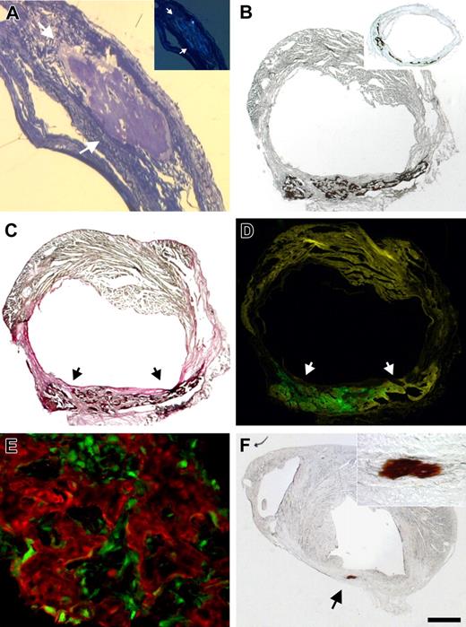 Figure 3. Calcifications and bone formation in the lesioned heart after injection of enriched MSCs. (A) Methylene blue–stained semithin section through the infarcted area of a heart 29 days after injecting 2 × 105 enriched MSCs (passage 3). Transmission light microscopy revealed an encapsulated formation (arrows) filling out almost the entire width of the scar. Polarization microscopy showed fluorescent areas within the amorphous material indicating calcifications (panel A inset). (B) Von Kossa staining evidenced massive calcifications (black deposits) 29 days after injecting 1 × 105 MSCs (passage 6) into the cryoinjured mouse heart. (Panel B inset) Similar calcifications were seen using von Kossa staining in an LCA mouse heart 28 days after injecting 1 × 105 MSCs (passage 5). (C) Combined van Gieson/von Kossa staining (same heart as shown in panel B) demonstrated that the calcifications (black, marked by arrows) were restricted to the infarcted area (red) and (D) contained high numbers of the injected EGFP+ MSCs (green, subsequent section). (E) Immunostaining with osteocalcin (Cy3, red) demonstrated that the injected EGFP+ MSCs (green) were cemented within trabecular-like bone structures (sample obtained from same heart as shown in panel B). (F) Similar calcifications but of smaller size were revealed by von Kossa staining (arrow) 21 days after injecting only 1 × 104 enriched MSCs (passage 6). The infarcted area of the heart is characterized by the thinned-out ventricular wall. Inset shows the area of calcification at higher magnification. Bar represents 180 μm (panel A), 550 μm (panel A inset), 650 μm (panel B), 1300 μm (panel B inset), 600 μm (panels C,D,F), 50 μm (panel E), 100 μm (panel F inset). See “Materials and Methods; Image acquisition and preparation” for microscopy details.