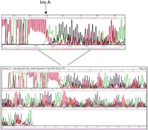Figure 1. Mutational analysis of the RBL2/p130 gene. Exon 21 has been sequenced and reveals an A insertion in the 20–21 intron-exon boundary.