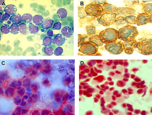 Figure 2. Morphology and immunohistochemistry of BL primary tumors and cell lines. (A) May-Grunwald Giemsa staining of cytologic smears showing the characteristic intracytoplasmic vacuoles. (B) Immunohistochemistry of BL primary tumors showing cytoplasmic localization of the pRb2/p130 protein suggestive of mutations within the nuclear localization signal. Immunohistochemistry of BL cells transfected with either the empty vector (C) or RBL2/p130 (D). Cytoplasmic localization of the pRb2/p130 protein is observed in empty vector–transfected cells whereas RBL2/p130-transfected BL cells show normal nuclear expression of pRb2/p130. Images were viewed by means of a Zeiss Aski Axioskop 40 microscope equipped with a Zeiss Axiocam H Rc (panels A, C, and D, 40×/0.65 NA; panel B, 63×/0.80 NA) (Zeiss, Vertrieb, Germany) and processed using Axiovision (Zeiss) software. Original magnification: panels A, C, and D, × 750; panel B, × 970.
