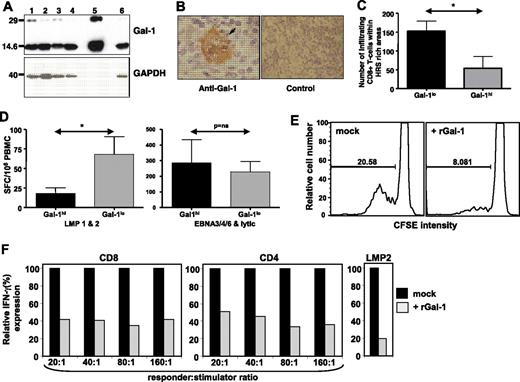 Figure 1. Galectin-1 (Gal-1) expression in Hodgkin lymphoma (HL) cell lines and human melanoma cell line.(A) Western blot analysis for galectin-1 (Gal-1) expression in Hodgkin lymphoma (HL) cell lines and human melanoma cell line: SKMa128 using an anti-Gal-1 antibody. Recombinant Gal-1 was used as a positive control. Lane 1: L428, lane 2: L540, lane 3: L1236, lane 4: HDLM2, lane 5: recombinant Gal-1, and lane 6: SKMel28. (B) Representative photomicrographs showing immunohistochemical staining with anti-Gal-1 or isotype control antibody in a mixed cellularity HL tumor biopsy. Hodgkin Reed-Sternberg cell shows strong Gal-1 expression most marked within the cytoplasmic rim. (Left panel) Original magnification ×40/.65 NA; (right panels) original magnification ×10/.25 NA using a CX41 (Olympus, Tokyo, Japan). Photomicrographs were taken using a Nikon Coolpix 5700 (Tokyo, Japan) and Microsoft Office XP Photo Editor (Seattle, WA) used for image acquisition. (C) Effect of Gal-1 expression on the CD8+ T cell infiltration in the tumor tissue. Data are presented as mean (± SE) of the number of infiltrating CD8+ T cells within Hodgkin Reed-Sternberg-rich areas in Gal-1hi and Gal-1lo HL patients. Asterisk denotes statistical significance (P = .048). (D) Effect of Gal-1 expression on Epstein-Barr virus (EBV)-specific CD8+ T cell response. Data are presented as a mean (± SE) of ex vivo EBV-specific interferon-γ spot-forming cells/106 peripheral blood mononuclear cells after stimulation with HLA class I-restricted epitopes from EBV proteins (LMP1 and 2: left panel; EBNA3/4/6 and lytic: right panel). All T cell responses were assessed before initiation of therapy, and the data were subdivided into Gal-1hi and Gal-1lo HL patients. Asterisk denotes statistical significance (P = .046). (E) Effect of recombinant Gal-1 on the proliferation of EBV-specific T cells. Peripheral blood mononuclear cells from EBV-seropositive patients were labeled with carboxy fluorescein diacetate succinimidyl ester, preincubated with Gal-1 at 1 μg/L (or mock-treated), and stimulated with autologous lymphoblastoid cell line at 20:1 responder: stimulator ratio. CD8+ T cell proliferation was assessed after 7 days culture. Results are representative of 5 separate experiments. (F) Effect of recombinant Gal-1 on the expression of interferon-γ by EBV-specific CD8+and CD4+ T cells. Peripheral blood mononuclear cells from EBV-seropositive patients were preincubated with Gal-1 at 1 μg/L (or mock-treated) and then stimulated with autologous lymphoblastoid cell line at different responder:stimulator ratios. Interferon-γ expression by EBV-specific CD8+, CD4+, and LMP2-specific CD8+ T cells were assessed using intracellular cytokine assay. LMP2-specific T cells were stained with APC-labeled major histocompatibility complex-peptide pentamer for HLA A2-restricted epitope CLGGLLTMV. Data are presented as relative interferon-γ expression by antigen-specific T cells with respected to the mock-treated cells. Results are representative of 2 separate experiments.