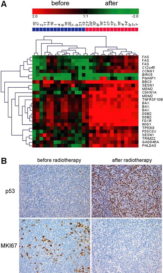 Figure 2. p53 pathway activation. (A) Hierarchic clustering of the samples taken before (blue) and after (red) radiation based on the 25 known p53 transcripts regulated by low-dose radiation. (B) p53 and MKI67 immunostaining was performed on paraffin sections of FL biopsies take before and after low-dose radiation. Images were acquired with a ColorView (Mitsubishi, Tokyo, Japan) SIS CCD camera (20×, PlanApo, 20×/0.09) and DP-Soft (Muenster, Germany) CVI 3.2 software. One representative field is shown.