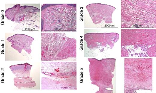 Figure 1. Dermal fibrosis grades 0 to 5. Each pair represents a different dermal fibrosis grade. The left-hand column of each pair containing low-power views (original magnification, × 2.5), illustrates the spectrum of change in the overall dermal breadth and distribution of fibrosis. The right-hand column views for each pair (original magnification, × 10), illustrate the qualitative size, shape, distribution, and density in the dermal collagen bundles and surrounding extracellular matrix. All sections are stained with H&E. Grade 0 is thin curlicue collagen bundles with only minimal focal papillary dermal sclerosis. Grade 1 is less than 25% sclerosis with focal dense deep dermal fibrosis. In grade 2, the dense zone of fibrosis within the hypodermis comprises less than 50% of the overall dermal breadth. The remaining reticular dermis is composed of fine collagen bundles with actinic change (blue) in the upper dermis. Higher power shows the distinction between the sclerotic and normal collagen bundles. Grade 3 is extensive sclerosis—more than 50%—throughout the dermis with thickened collagen bundles admixed with thinner bundles and intervening extracellular matrix. Grade 4 is pandermal fibrosis with loss of most extracellular matrix without extension into hypodermis (or entrapment of eccrine coils) or surrounding fat. Grade 5 is markedly fibrotic and thickened—more than 4 mm—dermis replaced with dense waxy collagen with deep extension into hypodermis with fibrous incorporation of a muscular artery. See “Patients and methods; Assessment of skin biopsies” for more information on images.
