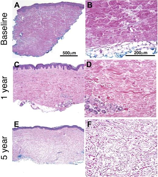 Figure 3. Resolution of dermal fibrosis after HDIT and autologous HCT. Full-thickness skin biopsies from patient no. 11, collected at baseline and then at 1 and 5 years after HDIT, were histologically evaluated (H&E). The skin biopsies performed after HDIT were performed at a site adjacent to the baseline skin biopsy. The biopsies in the left-hand column were taken at original magnification × 5, and those in the right-hand column were taken at original magnification × 20. All sections were stained with H&E. (A) Skin biopsy was obtained before HDIT and autologous HCT. Pandermal sclerosis from the dermal-epidermal border to the hypodermis (subcutaneous fat) was observed. The epidermis is mildly acanthotic (thickened) with loss of rete ridges. The reticular dermis is replaced by dense compact collagen without normal fascicular bundles or dermal appendages. This pretransplantation skin biopsy was determined as grade 5 dermal fibrosis. The thickness of the dermis was measured at more than 2 mm. (B) In the higher-power magnification, the straightened dermal-subcutaneous border demonstrates the abnormal, densely packed, homogenized collagen. (C) The skin biopsy at 1 year after HDIT was determined to be a grade 2 dermal fibrosis and has less fibrosis than at baseline. The low-power magnification view shows crowded collagen fascicles with focal areas of residual thickened bundles. (D) A higher-power view of the 1-year skin biopsy from panel C shows thin and collagen bundles admixed with residual thick straightened hypereosinophilic collagen bundles without dense homogenization at baseline. The residual eccrine unit lacks any surrounding adipose tissue. (E) The skin biopsy at 5 years shows complete resolution of the dermal fibrosis (grade 0) with a reduction in the thickness of the dermis from baseline to 1 mm. The collagen bands in the dermis are thin with a relative increase in the intervening extracellular matrix (space between the collagen bands). The dermal-epidermal border remains straightened with loss of rete ridges. (F) A higher-power view of collagen in the lower reticular dermis demonstrates the change to thin wavy bundles separated by increased ground substance. See “Patients and methods; Assessment of skin biopsies” for more information on images.