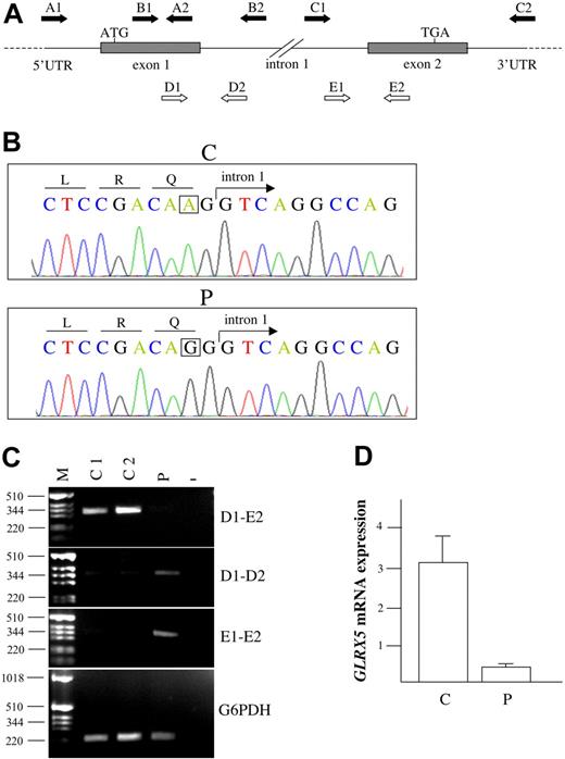 Figure 1. Genetic studies of the proband. (A) Schematic illustration of GLRX5 gene. The arrows indicate primers used for genomic amplification (A1-A2, B1-B2, C1-C2), for semiquantitative determination of cGLRX5 (D1-E2), and for exon-intron junction amplification (D1-D2, E1-E2) of proband and control cDNA. (B) Electropherograms of control (C) and proband (P) DNA in the region encompassing the exon 1–intron 1 boundary. The A→G homozygous mutation is boxed. (C) RT-PCR of GLRX5 cDNA from P and controls (C1, C2) PBMC and a negative control (−). From top to bottom: The fragments corresponding to correctly spliced cDNA, obtained by using primers D1-E2, are reduced in the proband. The genomic regions encompassing exon1-intron1 (primers D1-D2) and intron1-exon2 (primers E1-E2) boundaries amplified on cDNA are significantly increased in the proband, suggesting a splicing defect. The identity of the fragments was verified by sequencing. G6PDH was used as control of the reverse transcription reaction and to demonstrate lack of genomic contamination. (D) Relative gene expression of GLRX5 by qRT-PCR showing significant decrease in proband compared to controls. Error bars represent the standard error.