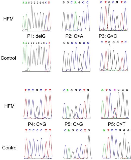Figure 1. Representative chromatograms of DNA sequence data. Top panels (HFM) represent the mutated DNA in patients with HFM, whereas the bottom panels (control) are corresponding wild-type sequences.