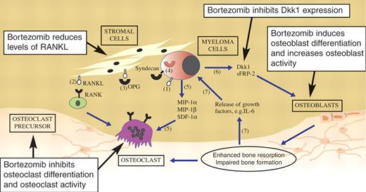 Figure 1. Pathophysiology of myeloma bone disease and the suggested sites of action of bortezomib. (1) Myeloma cells produce RANKL and (2) cause stromal cells to overexpress RANKL. Bortezomib reduces levels of RANKL. (3) OPG is the soluble RANKL antagonist. (4) Myeloma cells inhibit OPG production and also bind circulating OPG by syndecan-1, thus facilitating its internalization and degradation. Bortezomib restores the RANKL/OPG balance. (5) Myeloma cells express MIP-1α, MIP-1β, and SDF-1α, which recruit osteoclast precursors and enhance osteoclast activity. (6) Myeloma cells secrete Dkk1 and sFRP-2, which inhibit osteoblast differentiation and function. Bortezomib inhibits Dkk1 expression and increases osteoblast differentiation and activity. (7) The resulting enhanced bone resorption releases cytokines and growth factors that in turn promote myeloma cell proliferation and survival. Adapted from Heider et al7 with permission.