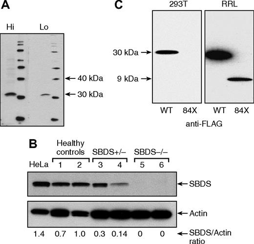 Figure 1. SBDS protein expression in peripheral blood lymphocytes. (A) A polyclonal antibody against the terminal 18 amino acids of the SBDS was generated in rabbits with adequate sensitivity and specificity at high (Hi, 1:500) and low (Lo, 1:2,000) dilutions, recognizing a protein with ∼31 kDa. (B) By Western blot, SBDS expression was evident in HeLa cells and peripheral blood lymphocytes from healthy controls, partially diminished in SBDS heterozygous aplastic anemia patients, and undetectable in patients with SDS. (C) FLAG-tagged SBDS (FLAG-SBDS-WT) and FLAG-tagged construct of SBDS N-terminal 84 amino acids (FLAG-SBDS-84X) were transfected into HEK 293T, but only the full-length protein was expressed (left panel), whereas in the cell-free rabbit reticulocyte expression system (RRL), both products were expressed.