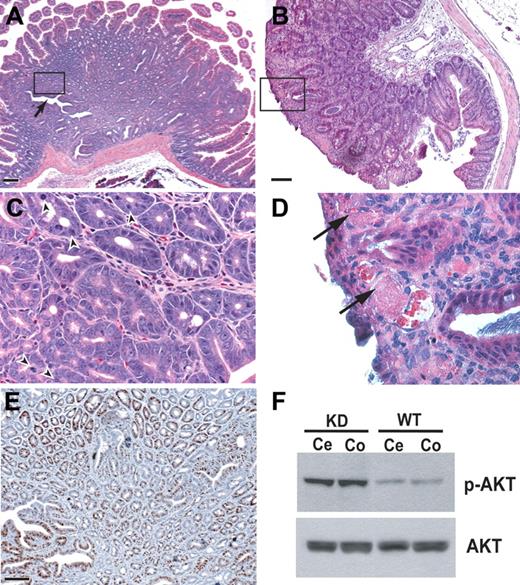 Figure 3. Intestinal polyposis in Bmpr2-deficient mice. Hamartoma-like polypoid mass formation in duodenum (A,C,E), and cecum (B,D) of Bmpr2 KD mice. (C,D) Enlarged views of the boxed area in panels A and B, respectively. Arrow in panel A indicates disorganized epithelial glands, and arrowheads in panel C point to mitotic figures and distorted nuclear morphology. (E) Ki67 staining of adjacent serial sections. Bars = 100 μm. (F) Immunoblots of protein extracts from cecum (Ce) and colon (Co) of a Bmpr2 KD mouse and its wild-type littermate using antibodies against phosphor-AKT and total AKT.
