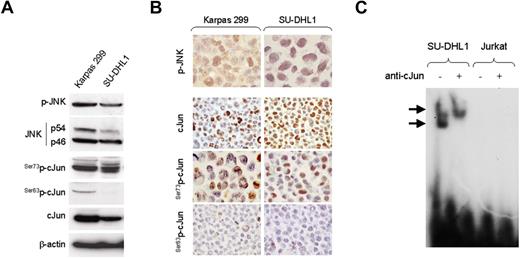Figure 1. Expression of activated JNK and cJun proteins and AP-1 DNA binding activity in NPM-ALK+ ALCL cells. (A) Two NPM-ALK+ ALCL cell lines, Karpas 299 and SU-DHL1, were examined by immunoblot analysis using antibodies specific for JNK, p-JNK, cJun, and its phosphorylated forms, Ser73p-cJun and Ser63p-cJun. JNK1 and JNK2 are expressed as isoforms of 46 kD and 54 kD, respectively, generated by alternate splicing. Both cell lines were found to express high levels of JNK and cJun, as well as their phosphorylated forms, with Ser73p-cJun being more prominent. Two Hodgkin lymphoma cell lines, L-428 and L-1236, served as positive controls and REH cells, derived from a patient with pre-B-ALL, served as a negative control, respectively, for expression of cJun and p-cJun (data not shown). (B) Immunochistochemistry was performed on formalin-fixed, paraffin-embedded Karpas 299 and SU-DHL1 cell blocks using the same antibodies for detection of cJun and their phosphorylated/activated forms. Both NPM-ALK+ ALCL cells revealed nuclear staining for cJun, Ser73p-cJun, and Ser63p-cJun. (C) AP-1 DNA binding activity was assessed in SU-DHL1 and Jurkat by EMSA using the double-stranded consensus oligonucleotides with AP-1–specific binding. Super shift of protein–DNA complex (arrow) was detected in SU-DHL1 cells when nuclear extracts were preincubated with (+) antibody against cJun, indicating the AP-1 complex in ALK+ ALCL cells contains cJun. AP-1 DNA binding activity was undetectable in Jurkat cells that served as a negative control in this experiment. Free DNA is shown in the bottom of the gel.
