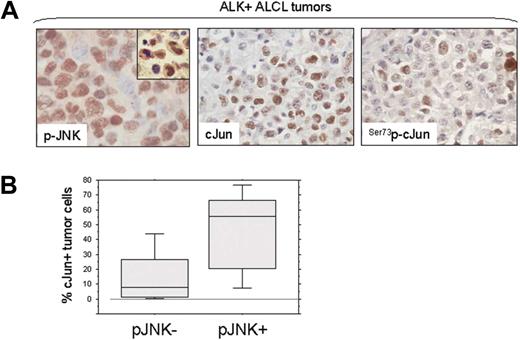 Figure 2. JNK and cJun activation in NPM-ALK+ ALCL tumors. (A) JNK and cJun phosphorylation were assessed in 22 ALK+ ALCL tumors using immunohistochemistry and a tissue microarray. Using a 10% cutoff, nuclear expression of p-JNK was found in 15 (68%) ALK+ ALCL, with most tumor cells being positive in the p-JNK+ group of tumors. cJun was expressed and was phosphorylated at serine 73 in a variable proportion of tumor cells, in accordance with our recently published data.30 Double immunostaining confirmed the coexpression of CD30 and p-JNK in tumor cells (inset: red, membranous CD30 expression; dark brown, nuclear p-JNK expression). (B) The median percentage of cJun+ tumor cells in ALK+ ALCL was significantly higher in tumors expressing p-JNK than in tumors negative for p-JNK (box and whisker plot). The boxes indicate percentages of cJun+ tumor cells between 25%-75%. The bars indicate percentages of cJun+ tumor cells between 5%-95%.