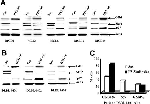 Figure 6. Cell-adhesion–induced p27Kip1-associated cell-cycle arrest through down-regulating the SCFSkp2 ubiquitin ligase pathway in primary MCL and other non-Hodgkin B-cell lymphomas. (A,B) The Cdh1, Skp2, and p27Kip1 expressions in primary MCL (A) and DLBCL (B) cells in suspension (Sus) versus HS-5 adhesion (HS5-Ad) were analyzed by Western blot. (C) Cell-cycle distribution in DLBCL (DLBL0401) cells in suspension (Sus), or on a confluent HS-5 monolayer (HS5-Ad; 12 hours).