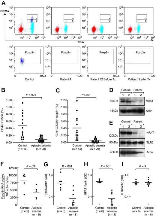 Figure 1. CD4+CD25+ T cells in patients with aplastic anemia and in healthy control subjects. (A) Peripheral blood mononuclear cells from patients with aplastic anemia and healthy control subjects were stained with anti-CD4 and anti-CD25 antibodies followed by intracellular anti-FOXP3 antibodies. The upper gate on the dot plots (gate a) represents CD4+CD25hi+ T cells and the lower gate (gate b) the CD4+CD25+ T cells. FOXP3 expression was gated on CD4+CD25hi+ T cell population (gate a). Representative dot plots are shown from a healthy control subject, a patient with aplastic anemia, and another patient before and after immunosuppressive treatment. Tx, treatment. (B,C) Relative numbers of CD4+CD25hi+ T and CD4+CD25hi+ FOXP3+ T cells from all healthy control subjects and patients with aplastic anemia examined are shown. All patients were examined before receiving any immunosuppressive treatment. Differences between patients and control subjects were statistically significant (P < .001). (D) CD4+CD25+ T cells' nuclear extracts from healthy volunteers and patients with aplastic anemia were analyzed for FOXP3 expression. All patients examined had significantly decreased FOXP3 protein levels compared with healthy donors (P < .001). All patients' samples were analyzed side-by-side with healthy donors' samples. (E) Cytoplasmic extracts from CD4+CD25+ T cells from patients and healthy donors were analyzed by immunoblot for NFAT1 expression. All patients examined showed diminished or undetectable NFAT1 protein levels compared with healthy control subjects (P < .001). All patients' samples were run side-by-side with control subjects' samples. There were no differences in TLR2 expression between patients and control subjects. (F) RNA from CD4+CD25+ T cells from patients with aplastic anemia and control subjects was analyzed for FOXP3 gene expression in quantitative polymerase chain reaction experiments. Patients with aplastic anemia showed decreased FOXP3 mRNA/actin copies compared with healthy control subjects (P = .03). Horizontal lines represent mean values. (G-I) The densitometric intensities of immunoblot results from all the subjects studied for FOXP3, NFAT1, and TLR2 expression are collectively presented. Horizontal lines represent mean values. Results are plus or minus standard error of the mean (± SEM).