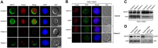 Figure 2. FOXP3 and NFAT1 in primary CD4+CD25+ T cells. (A) Purified CD4+CD25+ T cells from patients and healthy donors were analyzed by confocal microscopy for NFAT1 and FOXP3 expression. NFAT1 resided in the cytoplasm in unstimulated cells from control subject and FOXP3 was localized in the nucleus. All patients with aplastic anemia who were examined showed decreased or absent NFAT1 and FOXP3. Representative results are shown from at least 4 different experiments. In all experiments, patients' and control subjects' cells were stained in parallel. DIC indicates differential interference contrast; DAPI, 4′-6-diamidino-2-phenylindole. (B) Purified CD4+CD25+ T cells from patients and healthy donors were analyzed by confocal microscopy for FOXP3 expression after transient transfection with a wild-type NFAT1 construct. CD4+CD25+ T cells from healthy donors did not show any difference in FOXP3 expression after transfection with the NFAT1 construct. CD4+CD25+ T cells from patients showed significantly increased FOXP3 expression after the transfection. Representative results are shown from at least 4 different experiments. Patients' and control subjects' cells were transfected and stained in parallel. (C) NFAT1 levels in CD4+CD25− T cells were comparable between patients and control subjects. (D) Cytoplasmic and nuclear extracts from CD4+CD25+ T cells (from healthy donors, n = 2) transfected with NFAT1-siRNA were analyzed by immunoblot for NFAT1 and FOXP3 expression, respectively. The NFAT1-knockdown CD4+CD25+ T cells showed decreased FOXP3 expression compared with the cells that were transfected with a control small inhibitory RNA. See “Patients, materials and methods, Confocal microscopy and T-cell transfections” for detailed image acquisition information.