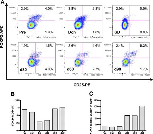 Figure 3. Treg reconstitution in a representative patient (UPN 301). Tregs were determined by flow and qRT-PCR analysis before and 30, 60, and 90 days after transplantation (Pre, d30, d60, d90, respectively); donor (Don) and the CD25-depleted lymphocyte product (SD). (A) Flow analysis for FOXP3 and CD25 in the CD4+ subset. Percentages displayed represent the fraction of positive cells in CD4+ cells. Two Treg populations, a CD25+ CD4+ FOXP3+ and a CD25− CD4+ FOXP3+ subset, could be identified before and after transplantation as well in the donor. The SD product was entirely CD25− but contained a CD25− CD4+ FOXP3+ subset of Tregs. CD25− CD4+ FOXP3+ and CD25+ CD4+ FOXP3+ Treg fractions increased after SCT. CD25+ CD4+ FOXP3− Teffs declined after SCT. (B) Total fraction of FOXP3+ cells in CD4+ cells. (C) Foxp3 mRNA expression in CD4-selected cells expressed as copy numbers per 1 × 106 copies of β-actin.