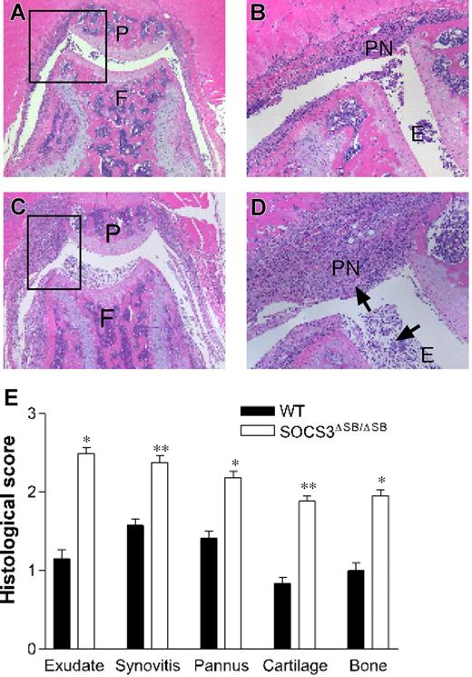 Figure 6. SOCS3ΔSB/ΔSB mice exhibit exacerbated mBSA/IL-1–induced acute arthritis. (A-D) Acute inflammatory arthritis was induced by intra-articular injection of mBSA into the knee joint followed by 3 daily subcutaneous injections of IL-1. Mice were killed on day 7. Frontal hematoxylin and eosin–stained sections through knee joints from arthritic WT (A-B) and SOCS3ΔSB/ΔSB (C-D) mice. E indicates exudate; P, patella; PN, pannus; F, femur; and arrows, increased exudate and inflammatory cells, predominantly neutrophils, in the joint space of treated SOCS3ΔSB/ΔSB mice. (E) Joint sections were graded for 5 features of inflammatory arthritis, each on a scale of 0 (normal) to 5 (severe) by an investigator blinded to the experimental groups. Results are shown as the mean (± SD) for 5 joints per group (*P < .05; **P < .01).