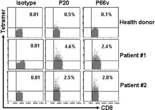 Figure 3. Naturally occurring DKK1-specific T cells in patients with MM. HLA-A*0201-peptide-tetramer staining showing the presence of DKK1 peptide-specific CD8+ T cells in the blood of 2 patients positive for HLA-A*0201 with MM. Percentages of cells are shown. Blood from a healthy donor who was HLA-A*0201+ was used as control.