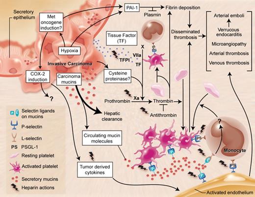 Figure 1. Multiple mechanisms in Trousseau's syndrome. There are multiple overlapping and interacting mechanisms that can explain the increased incidence of thrombosis in patients with malignancies. In Trousseau's syndrome, hypercoagulability manifests even before the diagnosis of the tumor and is probably the result of products arising from the tumor itself. The most common malignancies associated with this syndrome are carcinomas (cancers of epithelial origin) that are often, but not always, mucin producing. This cartoon depicts a mucin-producing carcinoma arising in a hollow organ, which secretes mucins with altered glycans inappropriately into the bloodstream. Although the bulk of these mucins are probably rapidly cleared by the liver, a small fraction are resistant to clearance and can interact with P- and L-selectins, inducing the formation of platelet-rich microthrombi by multiple pathways. Exposure of tissue factor (TF)–rich tumor cell surfaces to the bloodstream or the release of TF-rich microvesicles by the tumor is presumed to induce fibrin formation and platelet aggregation by thrombin production. There is some evidence for a cysteine proteinase secreted by carcinoma cells that can directly activate factor X to generate thrombin. Although interactions of platelet and endothelial P-selectin with P-selectin glycoprotein ligand-1 (PSGL-1) on monocytes may further contribute to these reactions, the exact mechanism by which mucins eventually generate thrombin and fibrin production is unknown. Hypoxic conditions within the tumor, the expression of the MET oncogene, or both might also enhance production of procoagulant factors such as TF and plasminogen activator inhibitor-1 (PAI-1), and tumor-derived inflammatory cytokines may serve to activate endothelial and platelet adhesion molecules. Various combinations of these mechanisms can help explain the unusual, migratory, and exaggerated thrombotic phenomena of Trousseau's syndrome. As indicated in the figure, heparin has potential salutary effects on many of the relevant processes. This may explain why heparin preparations of various kinds are the preferred agent for the management of Trousseau's syndrome.