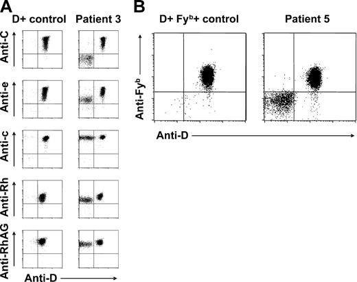 Figure 2. Red cell Rh antigen, Rh complex molecule, and Fyb antigen expression of patients with spontaneous mixed RhD phenotype. (A) Double-color flow cytometric analyses of Rh antigen D, C, e, and c, total Rh protein, and RhAG expression of RBC samples from patient 3 and a D-positive (CcDdee) control are shown. Note presence of C+c+D+e+ and C−c+D−e+ RBC subpopulations. Similar results were obtained with samples from patients 1, 2, 4, and 6. (B) Double-color flow cytometric analysis of D and Fyb antigen expression of patient 5 and a CcDdee, Fy(a+b+) control. Only the D-positive red cell subset of this patient is also Fyb positive.