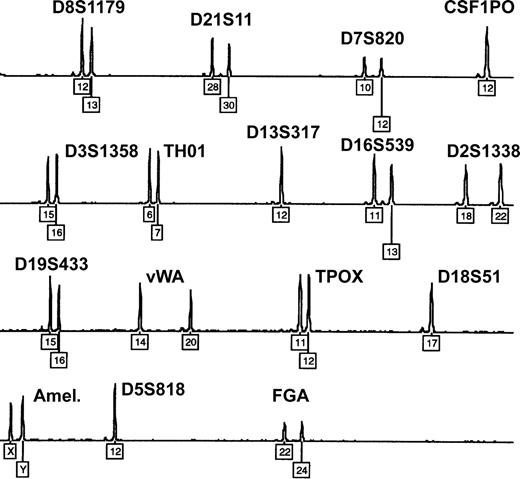 Figure 3. Exclusion of congenital or acquired chimerism by microsatellite marker analysis. Representative electropherogram showing the blood DNA profile of patient 1 after multiplex-PCR of 15 highly polymorphic autosomal short tandem repeat loci and amelogenin (Amel.). Numbers denote allelic designations of individual loci. No additional allelic peaks and only well-balanced heterozygous peaks are observed. Similar results were obtained with samples from the other 8 patients.