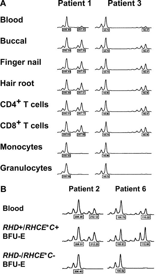 Figure 4. Loss of heterozygosity (LOH) on chromosome 1 in patients with spontaneous Rh phenotype splitting. (A) Myeloid lineage–restricted LOH on chromosome 1. Representative electropherograms of the D1S2697 and D1S2864 microsatellite markers with DNA samples from blood, different tissues, and sorted blood cell subsets of patient 1 and 3, respectively, are shown. Note pronounced peak imbalance in blood, and apparent LOH in myeloid cell subsets. Similar results were obtained with samples of patients 1, 2, and 9 and further microsatellite markers (as indicated by ‡ in Table 3). (B) LOH on chromosome 1 in RHD−/RHCE*C− (only RHCE*c+/RHCE*e+) but not in RHD+/RHCE*C+ (and additionally RHCE*c+/RHCE*e+) erythropoietic blast-forming units (BFU-Es). Representative electropherograms of the D1S233 and D1S199 microsatellite markers with DNA samples from blood and single BFU-Es of patient 2 and 6, respectively, are shown. Similar observations were made with samples of patients 2, 3, and 6 and with other microsatellite markers (all markers showing LOH as given in Table 5). Peak heights represent fluorescence intensity; numbers denote relative fragment size (bp).