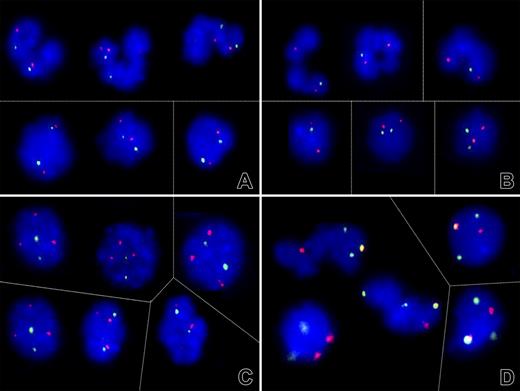 Figure 6. Evidence for different mechanisms of loss of heterozygosity on chromosome 1. (A-C) Dual-color fluorescent in situ hybridization signal patterns of selected cell nuclei obtained with PAC clones that encompass the RHD/RHCE (FITC, green) and, as a control, AF1q gene sequences (Cy3, red). (A) As shown here for patient 9, both the segmented (top) and round (bottom) nuclei in 4 of 6 analyzed cases contained 2 signals each and, thus, 2 RH gene loci. (B) The lack of one green signal in the majority of segmented nuclei and a minority of round nuclei of patient 3, on the other hand, confirmed a monoallelic deletion of at least the RHD/RHCE gene locus. (C) The 2 green RH and 3 red AF1q signal pattern in patient 6 prompted further investigations that (D) confirmed the presence of 3 chromosome 1 (green) and 2 chromosome 7 (red) centromeres with one colocalization (orange). This pattern reflects the presence of a der (1;7)(q10;p10), a highly specific chromosome abnormality in particular subtypes of myeloid malignancies. Thin lines separate individual images of representative cell nuclei. Signals were recorded after overnight incubation at 37°C. Images were visualized using a Zeiss Axioplan microscope equipped with 100×/1.45 alpha Plan-Fluar lens (Carl Zeiss, Heidelberg, Germany). Images were acquired using a Photometrics (Tucson, AZ) charge-coupled device camera, and IPLAB software (VYSIS, Stuttgart, Germany), and were processed using PowerPoint (Microsoft, Redmond, WA). Original magnification × 1000. Thin lines separate individual images of representative nuclei.
