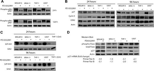 Figure 5. THP-1 and U937 cells can rephosphorylate pRb after multiple days of PD0332991 treatment by reactivating CDK2. (A) Western blot. The indicated AML cell lines were treated with DMSO (vehicle control) or PD0332991 (500 nM) for 24 or 120 hours. Lysates were resolved by SDS-PAGE followed by immunoblotting with anti-pRb. (B) Western blot. Cells were treated for 24 or 96 hours with PD0332991 (500 nM) or DMSO (vehicle control). Lysates were subjected to SDS-PAGE followed by Western blot analysis with the indicated antibodies. An antibody against actin was used as a loading control. (C) CDK2 in vitro kinase assay: Cells were incubated for 96 hours with DMSO (vehicle control) or PD0332991 (500 nM). Cell lysates were prepared and normalized by protein concentration. CDK2 was immunoprecipitated to perform the in vitro kinase assay. Incorporation of 32P in the CDK2 substrate histone H1 was assessed by SDS-PAGE followed by autoradiography. As a control for the kinase assay, a lysate from THP-1 cells was incubated with an isotype-matched antibody to form an immunocomplex. To confirm equal protein amounts in each normalized extract, aliquots were separated by SDS-PAGE and analyzed by Western blot with an anti-Grb-2 antibody. (D) Western blot and real-time PCR. The indicated AML cell lines were treated with DMSO (vehicle control) or PD0332991 (500 nM) for 96 hours. Lysates were prepared and resolved by SDS-PAGE followed by immunoblotting with phospho-Foxo3a (Thr32), Foxo3a, p27, and actin as a loading control. The cells were also used to prepare mRNA to determine by real-time PCR the pairwise changes in p27 mRNA levels between DMSO- and PD0332991-treated cells. Two primer pairs were used for the analysis.