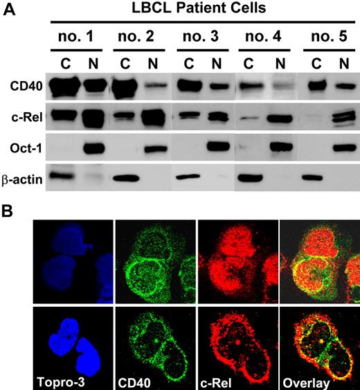 Figure 6. CD40 and c-Rel are expressed in the nucleus of LBCL patient cells. (A) LBCL patient samples (nos. 1-5) were collected as described in “Materials and methods.” Cytosolic and nuclear fractions were extracted and subjected to Western blot analysis. C indicates cytosolic fraction; N, nuclear fraction. (B) Representative patient samples were stained with CD40- and c-Rel–specific antibodies and protein localization was visualized with Cy3 (red) and FITC (green) secondary antibodies under confocal microscope. Nuclear marker Topro-3 (blue) showed the cell nucleus. See “Confocal microscopic analysis” for image acquisition information.