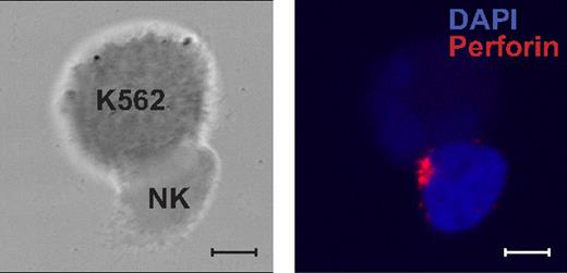 Figure 6. Polarization of secretory lysosomes in Stx11-deficient resting NK cells. Resting NK cells from a FHL4 patient mixed with K562 target cells. Cells were fixed, permeabilized, and stained with antiperforin mAb (red) and DAPI (blue). Left panel shows a differential interference contrast (DIC) image. The right panel shows overlay of nuclear staining with DAPI and antiperforin mAb. Scales represent 5 μm.