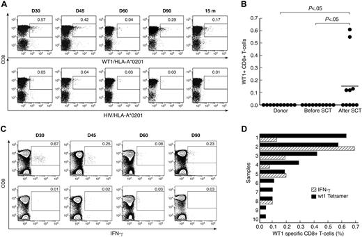 Figure 1. CD8+ T-cell responses to WT1 in donors and patients with ALL after SCT. (A) Tetramer analysis of PBMCs was performed by 6-color flow cytometry. Longitudinal data from patient 1 are presented. WT1/HLA-A*0201+ CD8+ T cells were gated on CD3+ events after passing through a small lymphocyte gate; HIV/HLA-A*0201 tetramer was used similarly as a negative control. (B) Comparison of frequency of WT1/HLA-A*0201+ CD8+ T cells in samples before SCT and after SCT. The values represent the maximal WT1/HLA-A*0201+ CD8+ T-cell response for each patient before and after SCT. Bars represent means. (C) IFN-γ production by CD8+ T cells in PBMC samples from patient 1, cultured for 6 hours with (top panel) or without (negative control; bottom panel) WT1 peptide. Results are expressed as percentages of CD8+ T cells. (D) Frequencies of WT1-specific CD8+ T cells by tetramer analysis () and WT1-specific IFN-γ producing CD8+ T cells ().