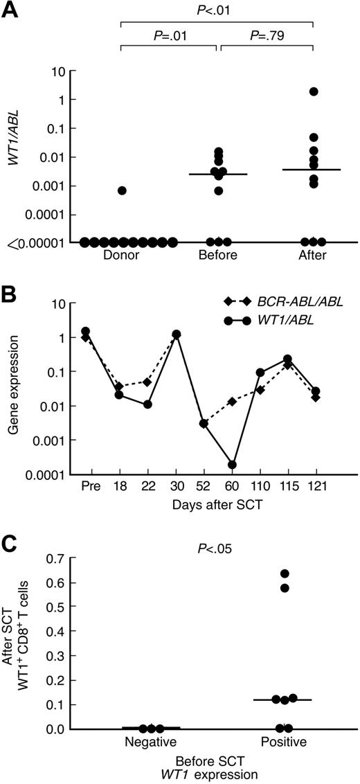 Figure 2. Relationship between WT1-specific CD8+ T-cell responses and WT1 gene expression in peripheral blood of patients with ALL and donors. (A) WT1 gene expression in peripheral blood samples from healthy donors, patients with ALL before SCT and after SCT. (B) Correlation between WT1 and BCR-ABL expression in PB samples from patient 2. (C) Relationship between WT1-specific CD8+ T-cell frequencies in PB samples after SCT and WT1 gene expression in PB samples obtained before SCT. Bars represent medians.