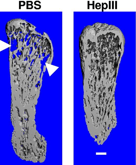 Figure 2. Treatment with HepIII protects implanted bones from osteolysis. At the termination of the experiment, implanted human bones were excised and imaged by microcomputed tomography (microCT). Shown are the three-dimensional reconstructions of the bones (sliced longitudinally through the midpoint of each specimen) injected with cells from patient 4 followed by treatment of the animal with either PBS (excessive bone resorption is seen) or HepIII (no bone resorption is observed, trabecular bone is intact). The areas of increased osteoclastic bone resorption in the PBS-treated sample are indicated by arrowheads. Note the appearance of the blue background behind the bone from the PBS-treated sample, indicative of resorption through the entire specimen. Scale bar equals 1 mm.