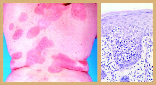 Mycosis fungoides. Reprinted from Willemze et al2 with permission.