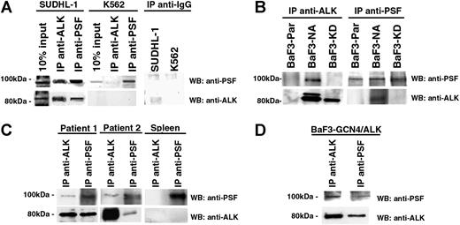 Figure 2. PSF coimmunoprecipitates with ALK fusion proteins expressed in cell lines and ALCL tumors. Reciprocal immunoprecipitation (IP) and Western blotting (WB) experiments were performed using anti-ALK1 and anti-PSF antibodies on lysates derived from (A) NPM/ALK+ SUDHL-1 cells and NPM/ALK− K562 cells; (B) BaF3-NPM/ALK (BaF3-N/A), BaF3-Parental (BaF3-PAR), and BaF3 cells expressing kinase-dead NPM/ALK (BaF3-KD); (C) lymph node tissue taken from 2 patients with NPM/ALK+ ALCL and NPM/ALK− spleen tissue; and (D) BaF3 cells expressing GCN4/ALK (BaF3-GCN4/ALK). As an internal control, SUDHL-1 and K562 cells were subjected to IP with an anti-IgG antibody (A).