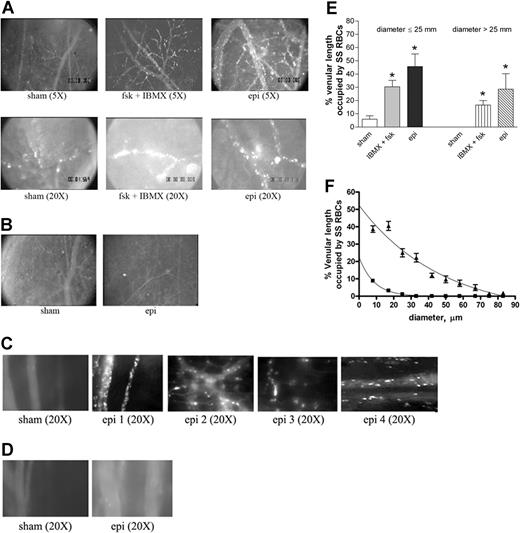 Figure 3. Epinephrine stimulates activation of SS, but not normal, RBC adhesion to vessel walls in nude mice. (A-D) Microscopic observations of postcapillary venules were conducted through implanted window chambers after infusion of RBCs into the tail vein of nude mice using × 5 and × 20 magnification to observe human RBCs and × 20 magnification to observe murine RBCs. Vessels without adherent cells appear gray due to rapidly moving fluorescent RBCs. (A) Infusion of sham-treated (n = 8), forskolin (fsk) + IBMX–treated (n = 3) or epi-treated (n = 8) human SS RBCs. Sham-treated human SS RBCs showed little adhesion to vessel walls, whereas fsk + IBMX–treated and, to a greater extent, epi-treated human SS RBCs showed marked adhesion to postcapillary venules, with intermittent vaso-occlusion, as indicated by arrows. (B) Infusion of sham-treated (n = 3) or epi-treated (n = 3) normal human RBCs. Sham-treated human normal RBCs showed no adhesion to venule walls. Epi had little to no effect on human normal RBC adhesion to vessel walls. Scale bar = 200 μm. (C) Infusion of sham-treated (n = 4) or epi-treated (n = 4) murine sickle cells. Sham-treated murine SS RBCs showed very weak adhesion to vessel walls. Epi increased adhesion of murine SS RBCs to postcapillary venules. (D) Infusion of sham-treated (n = 3) or epi-treated (n = 3) normal murine RBCs. Sham- or epi-treated normal murine RBCs showed no adhesion to venule walls. (E) Fsk + IBMX or epi enhances human SS RBC occupation of venular length. SS RBCs were sham treated, IBMX + fsk treated, or epi treated (n = 3 for each treatment) prior to infusion into the tail vein of nude mice. The values of 30 segments of vessels analyzed were averaged among groups of animals to represent the mean percent venular length occupied by SS RBCs. Error bars show SEM of 3 different experiments for each treatment. *P < .05 compared with sham-treated regardless of the vessel diameter within the ranges specified. (F) Percentage venular length occupied by human SS RBCs related to venular diameter. Animals were injected with sham- (■) or epi-treated (▴) SS RBCs. Error bars show SEM for 6 different experiments for each treatment. *P < .001 compared with sham-treated. Data were compared using 1-way ANOVA analysis followed by Bonferroni corrections for multiple comparisons.