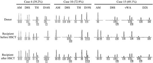 Figure 1. Representative STR patterns of donor blood cells (top), those of recipients before HSCT (middle), and those of nails in recipients after HSCT (bottom) are shown (cases 4, 10, and 15). The percentages in parenthesis were calculated by dividing the donor-derived short tandem repeat (STR) areas by the total STR peak areas in nails of recipients. The numbers of the fragment repeats are indicated below each STR. AM indicates amelogenin gene; D8S, D8S1179; TH, TH01; D16S, D16S539; D19S, D19S433; vWA, von Willebrand factor intron A; and D2S, D2S1338.