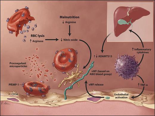 Figure 4. Proposed model for cytoadhesion of parasitized RBCs to CD36. Infected RBCs expressing PfEMP-1 can bind to CD36 (platelet glycoprotein IV) determinants on other cells. On the left, an infected cell binds to endothelial CD36 (direct sequestration). In the center, an infected cell binds to CD36 expressed on activated platelets, which in turn bind to endothelial cells via VWF. The lower levels of VWF in group O patients may confer a survival advantage. Inflammation, endothelial activation, NO depletion, reduced ADAMTS13 activity, and procoagulant microparticles may contribute to cytoadhesion. TNF-α, tumor necrosis factor α; ADAMTS13, a disintegrin-like and metalloprotease with thrombospondin type 1 motifs. Copyright Kimberly Main Knoper; used with permission.