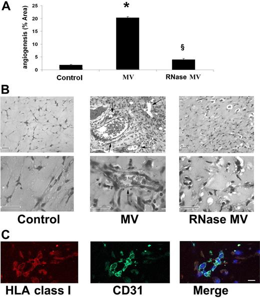 Figure 5. In vivo proangiogenic effects of EPC-derived MV. Formation of vessels after 7 days by HMECs preincubated (30 minutes at 37°C) with 30 μg/mL of MVs and then injected subcutaneously in Matrigel in SCID mice. (A) Quantitative evaluation of angiogenesis induced by MVs or by RNase-treated MVs. Angiogenesis was evaluated as the percentage of vessel area, and data are expressed as mean (± 1 SD) of 6 experiments. Analysis of variance with Newmann-Keuls test was performed; *P < .05 MVs versus control; §P < .05 RNase MVs versus MVs. (B) Representative micrographs of hematoxylin and eosin staining of Matrigel plugs obtained by Zeiss Axioskop (Jena, Germany) using ×100 and ×250 objectives. We considered as patent vessels those connected with the murine vasculature as shown by the presence of erythrocytes in the lumen (arrows). (Scale bar, 20 μm). (C) Representative confocal micrographs (Zeiss LSM 5 Pascal confocal Laser scanning microscope equipped with an Helium/Neon 543 mm laser, an Argon 450-530 mm laser, and an EC planar NEOFluar 40×/1.3 oil DIC objective lens; acquisition software, Zeiss LSMS version 3.2) showing the expression of human HLA class I antigen and human CD31 by HMEC-formed vessels within the implanted Matrigel (scale bar, 10 μm).