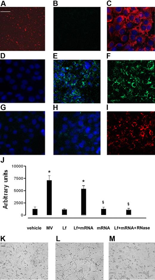 Figure 6. mRNA transfer by EPC-derived MVs. HMECs (5 × 104 cells/well) were incubated for 24 hours in DMEM plus 5% BSA with 10 μg/mL MVs derived from GFP-EPC, and the synthesis of GFP protein was evaluated by confocal microscopy (Zeiss LSM 5 Pascal confocal Laser scanning microscope equipped with an Helium/Neon 543 mm laser, an Argon 450-530 mm laser, and an EC planar NEOFluar 63 × 1.4 oil DIC objective lens; acquisition software, Zeiss LSMS version 3.2). (A) Representative micrograph showing MVs labeled with the PKH26 red fluorescent dye. (B) Representative micrograph showing that the green fluorescence of GFP was not detectable by confocal microscopy in MVs derived from GFP-EPC. (C) Representative micrograph showing the uptake of PKH26-labeled MVs by HMECs after a 30-minute incubation at 37°C. (D-G) The detection is shown of green fluorescence in HMECs incubated with MVs derived from GFP-EPC after 30 minutes (D), 6 hours (E), 24 hours (F), or 72 hours (G) at 37°C. (H) Treatment with RNase abrogated the expression of GFP by HMECs incubated for 24 hours at 37°C with MVs derived from GFP-EPCs despite that labeled MVs were internalized by HMECs (I). Three experiments were performed with similar results. Scale bar, 10 μm. (J-M) Effect of MV mRNA extracts on in vitro angiogenesis assay. HMECs (5 × 104 cells/well) were plated on growth factor–reduced Matrigel in DMEM plus 0.25% BSA and were challenged with vehicle alone or were stimulated with 10 μg/mL MVs or with 6μg Lipofectamine 2000 (Invitrogen) alone (Lf) or Lf plus 3 μg MV mRNA extracts, 3 μg mRNA alone, and 1 U/mL Rnase plus Lf plus MV mRNA extracts for 6 hours at 37°C. (J) Data show the mean (± 1 SD) of total length of capillary-like structures expressed as arbitrary units by the computer analysis system in 5 different files at ×20 magnification in duplicated wells of 4 different experiments. Analysis of variance with Newmann-Keuls multicomparison test was performed; *P < .05 treatments versus vehicle; §P < .05 mRNA alone or Lf plus mRNA plus RNase versus Lf plus mRNA extracts. (K-M) Representative micrographs showing the capillary-like structure formation on Matrigel by HMECs unstimulated (K) and stimulated with either (L) Lf + mRNA extracted from MVs or (M) with Lf + mRNA + RNase (Scale bar, 20 μm). The images were obtained by Nikon inverted microscope coupled with Casti Microimage analysis system as described in “In vitro angiogenesis.”
