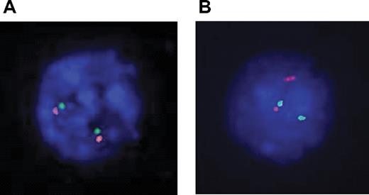 Figure 2. Interphasic dual color 10q24 FISH. Probes were labeled as follows: TLX1-5′ FITC, green signal; TLX1-3′ rhodamine, red signal. (A) Two fusion signals, indicative of 2 intact 10q24 loci. (B) A fusion signal and a split signal, indicative respectivley of a normal 10q24 locus and a 10q24 locus rupture, suggesting a translocation.