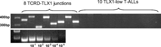 Figure 3. Multiplex-PCR products of TCRD-TLX1 junctions in T-ALLs. Top lanes: TCRD-TLX1 junctions among 8 TLX1-high T-ALLs. Next to these are loaded 10 representative products of the same PCR experiment, performed on 30 TLX1-low samples. No TCRD-TLX1 junction was amplified among the 30 TLX1-low T-ALLs tested. Bottom lanes: Logarithmic dilutions estimated the PCR sensitivity to reach 10−3/−4. The DNA ladder appears on the left.