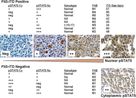 Figure 1. Relationship between Flt3-ITD status and distribution of phospho-STAT5 between nucleus and cytoplasm. The relative staining intensity for pSTAT5 was determined by manually scoring slides using a scale of 0 (neg) to 3 (+++) obtained from fixed bone marrow core biopsy of newly diagnosed patients with AML. Those scored as neg did not have detectable pSTAT5, and those scored as 3 had the highest intensity of staining. Shown are examples of patient samples with staining for nuclear pSTAT5 at each level. A patient sample showing predominant cytoplasmic pSTAT5 (++) is shown for comparison. Flt3-ITD status was determined by PCR on marrow clot sections using capillary electrophoresis. pSTAT5 Cy indicates cytoplasmic; pSTAT5 Nu, nuclear; and NA, not available. Slides were viewed with an Olympus BX50 microscope (Olympus, Center Valley, PA) using a 50×/0.90 oil-immersion objective lens and pSTAT5 immunostains. Images were acquired with an Insight 11.2 color mosaic camera (Diagnostic Instruments, Sterling Heights, MI) and processed with Spot Basic 4.1.3 (Diagnostic Instruments) and Adobe Photoshop elements 2.0 (Adobe, San Jose, CA) software.