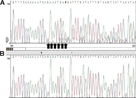 Figure 1. Sequence traces and restriction enzyme-based assessment of the new JAK2 mutation. (A) Electropherogram showing the c.51324–51329 deletion in exon 12 of the JAK2 gene. The arrows indicate the position of deleted nucleotides. (B) DNA gel electrophoresis DNA of exon 12 including the deletion before (lanes 1, 3, and 5) and after (lanes 2, 4, and 6) digestion with MboII, derived from patients (lanes 1 trough 4) and control (lanes 5 and 6). MW indicates 50-bp ladder DNA molecular-weight markers; and *, the 195-bp fragment containing the deletion and lacking of a MboII site, which substitutes for 115-bp and 86-bp fragments (arrows).