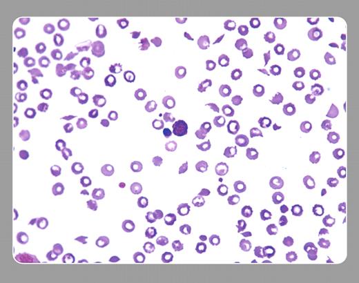 Neil Abramson, Baptist Cancer Institute. / A 57-year-old woman with breast cancer refractory to several combinations of chemotherapy was placed on a regimen that included mitomycin. She showed objective improvement. After 3 months of therapy, thrombocytopenia, anemia, and azotemia developed. The peripheral smear, seen above, shows numerous schistocytes, moderate thrombocytopenia, and a nucleated red cell. Many red cells have well-demarcated centers that represent artefacts. Coagulation tests were normal. Chemotherapy was withheld, and plasma exchange afforded marginal benefit. She died months later with extensive metastatic disease and pathologic evidence of microvascular thrombotic disease. / The peripheral smear affirmed the clinical picture of thrombotic thrombocytopenic purpura (TTP). Mitomycin was one of the first drugs causally related to TTP. Several other drugs (clopidogrel, ticlopidine, cyclosporine, et cetera), including several other chemotherapy agents, especially when used with autologous and allogeneic marrow transplantation, can result in the same peripheral smear. / TTP may be a final common pathway of several different processes, some of which include immunologic diseases, infectious processes, and malignancy (by itself or associated with its treatment). Most cases of TTP show congenital or acquired deficiencies or dysfunction of the ADAMTS 13 protease. With the patient noted above, the measurement of this protease was unavailable.